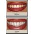 Teeth Whitening Meridian